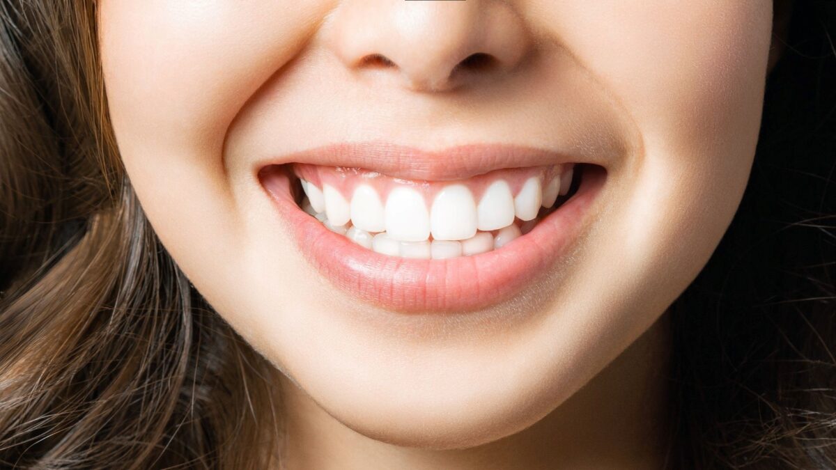Top 6 Benefits of Professional Teeth Whitening