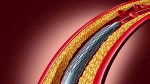 Global Absorbable Heart Stent Market Size, Share, Growth, & Forecast  Report by 20288