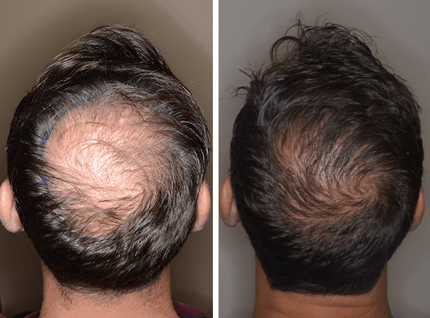PROS AND CONS OF HAIR TRANSPLANT