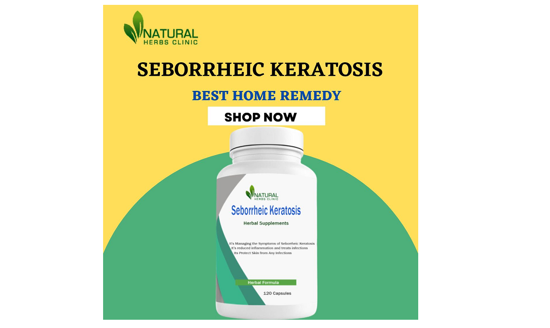 Seborrheic Keratosis: Read the Natural Treatments with Detail