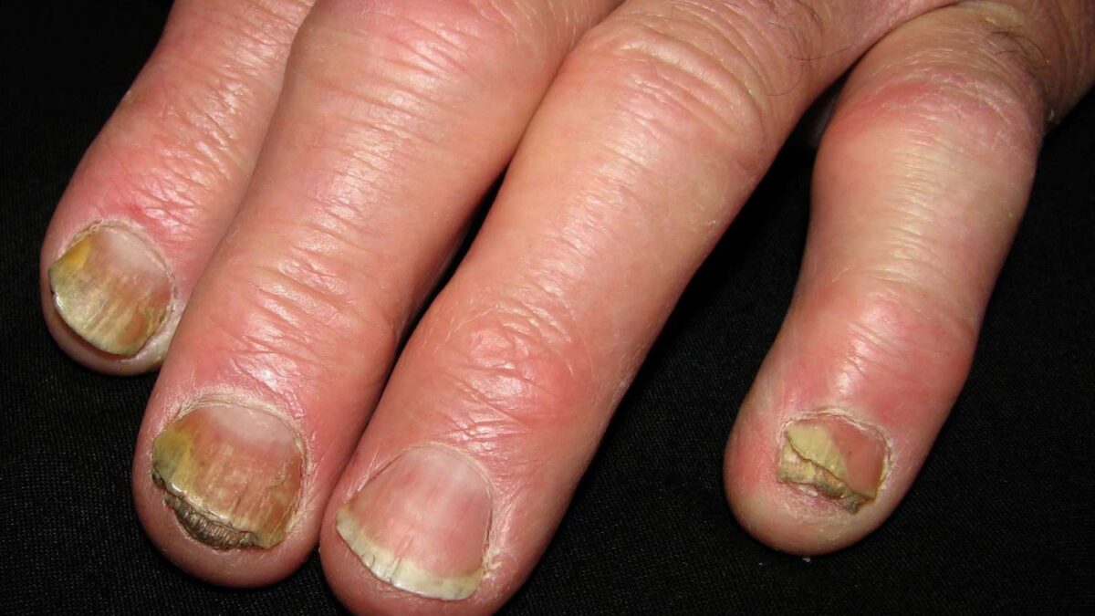 Causes Of Nail Infections Eczema