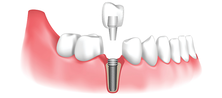 Dental Implant In London Ontario: Types, Procedure And Its Benefits