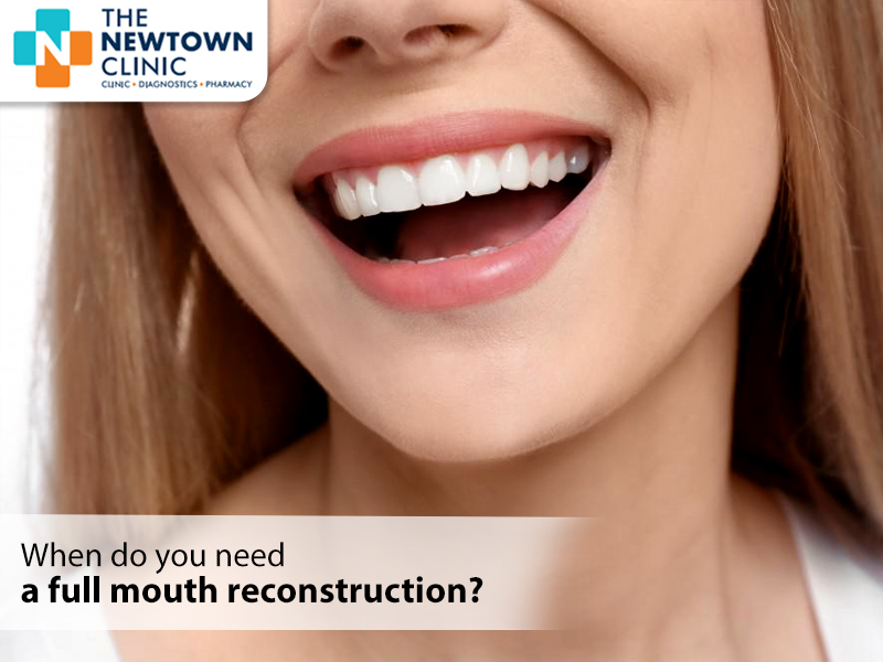 When Do You Need A Full-Mouth Reconstruction?