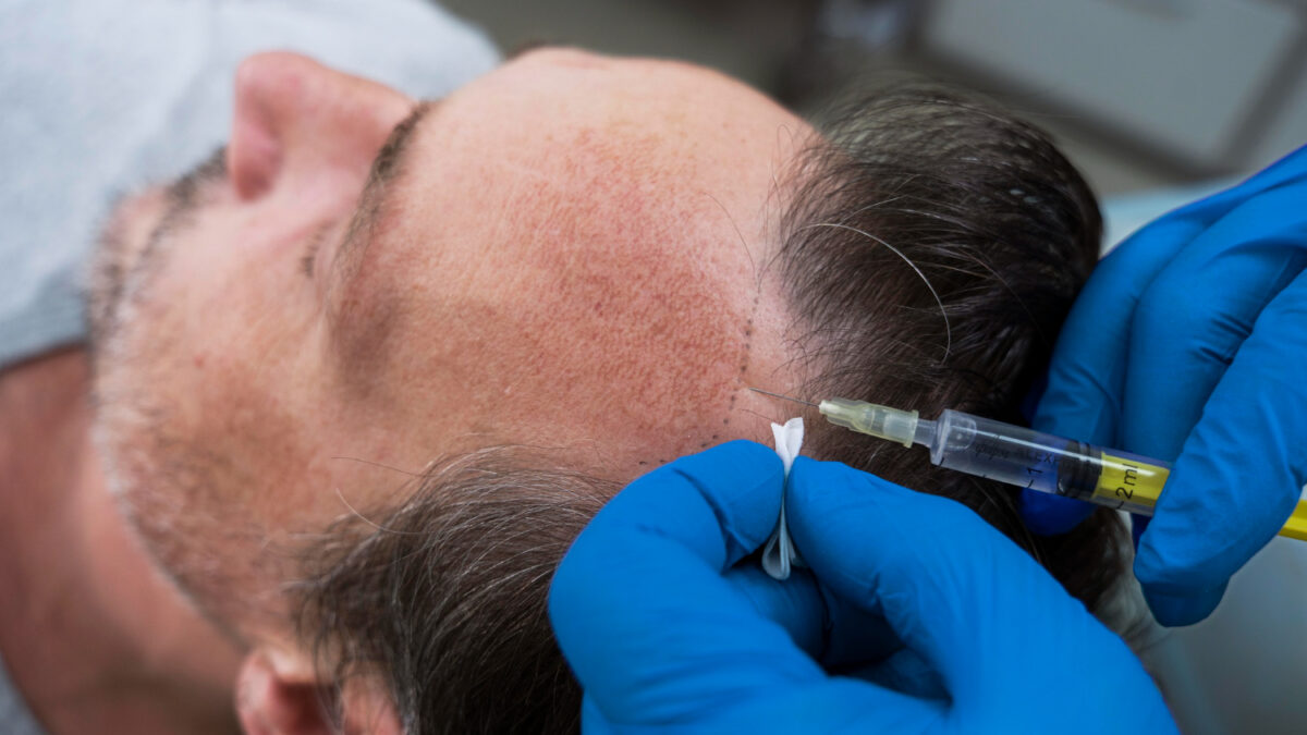 Hair Transplants Can Provide Permanent And Natural Results.