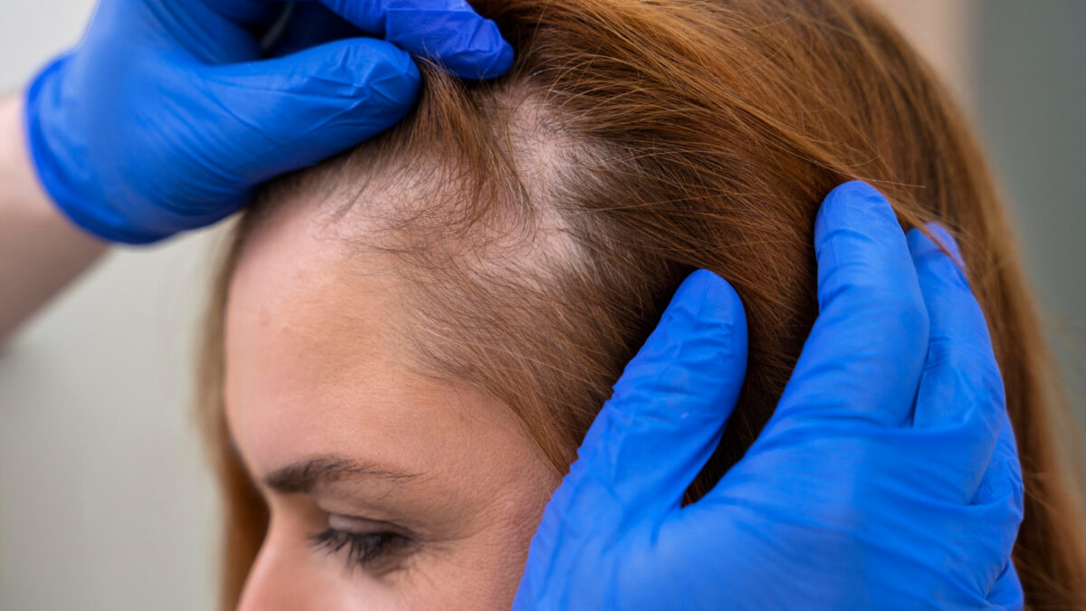 What do you know about hair transplants in women?