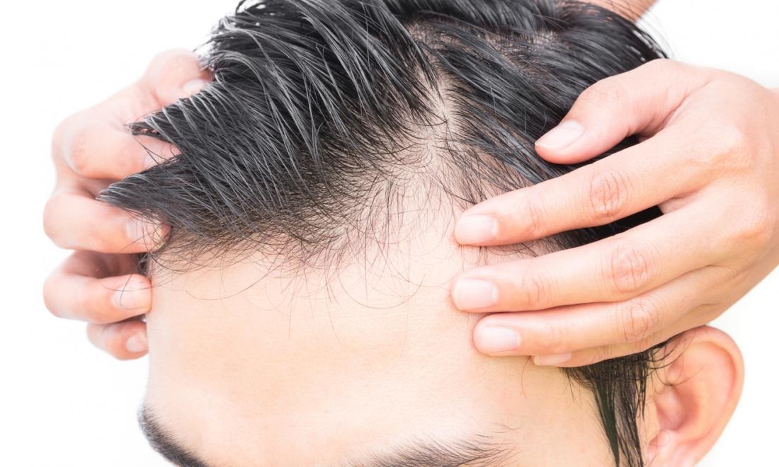 Explain The Factors That Affect Hair Transplant Cost in Agra