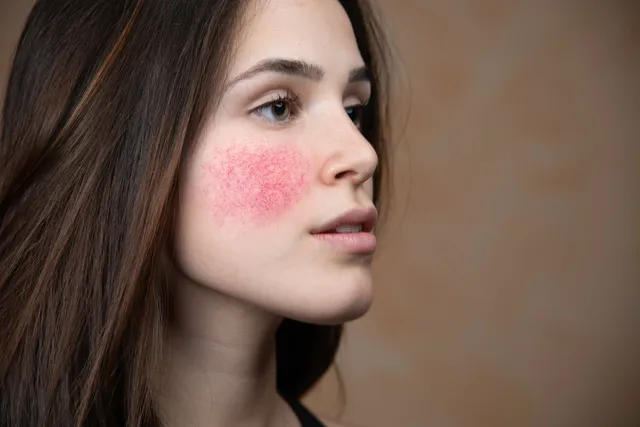 Rosacea Unmasked: Unveiling The Secrets To Clear Skin
