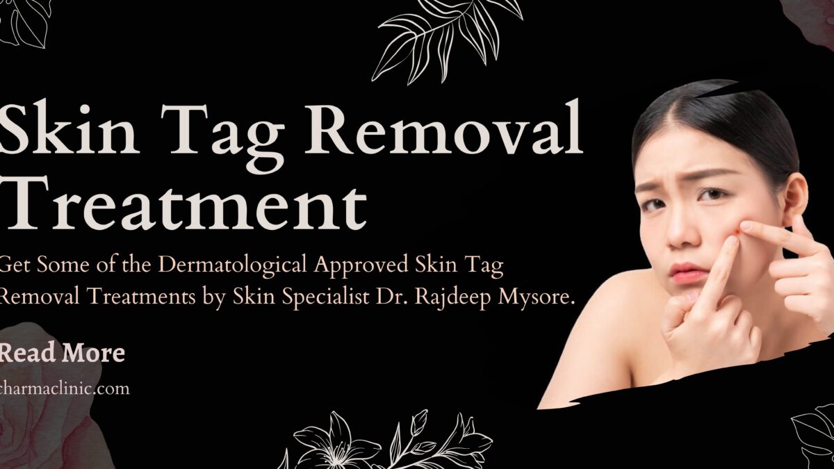 Skin Tag Removal Guide by Dermatologist