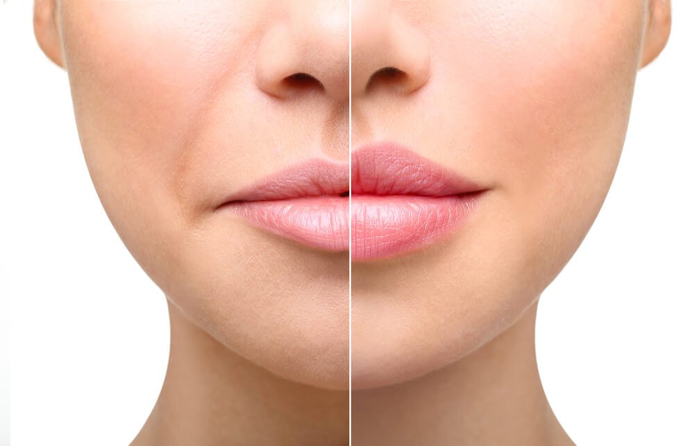 Elevate Your Beauty with Lip Fillers in Phoenix: A Comprehensive Guide