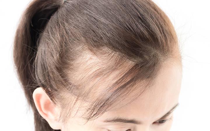 How To Get Rid of Female Pattern Baldness By Hair Transplant?