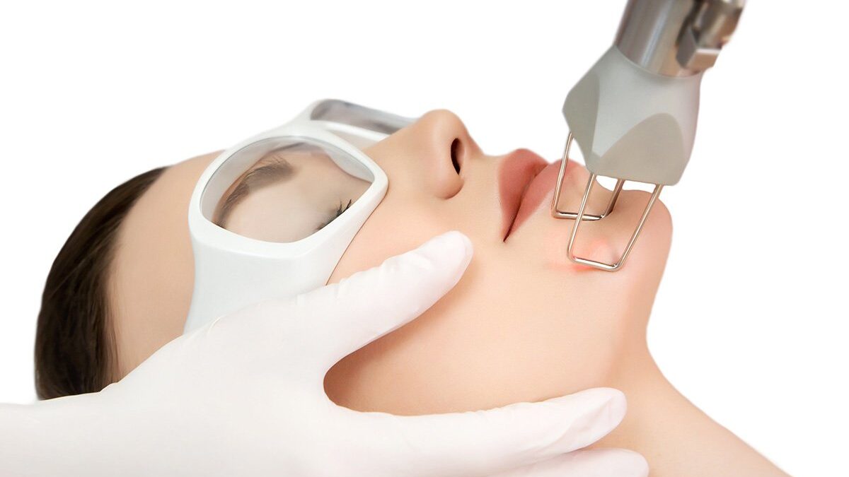 How Laser Treatment for Acne Scars can Transform  Your Complexion