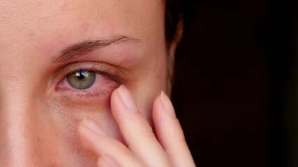 Viral Conjunctivitis Red Eye Treatment: Everything You Need to Know