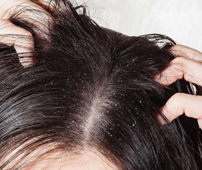 When to Seek Professional Help: Signs Your Greasy Dandruff Needs Attention