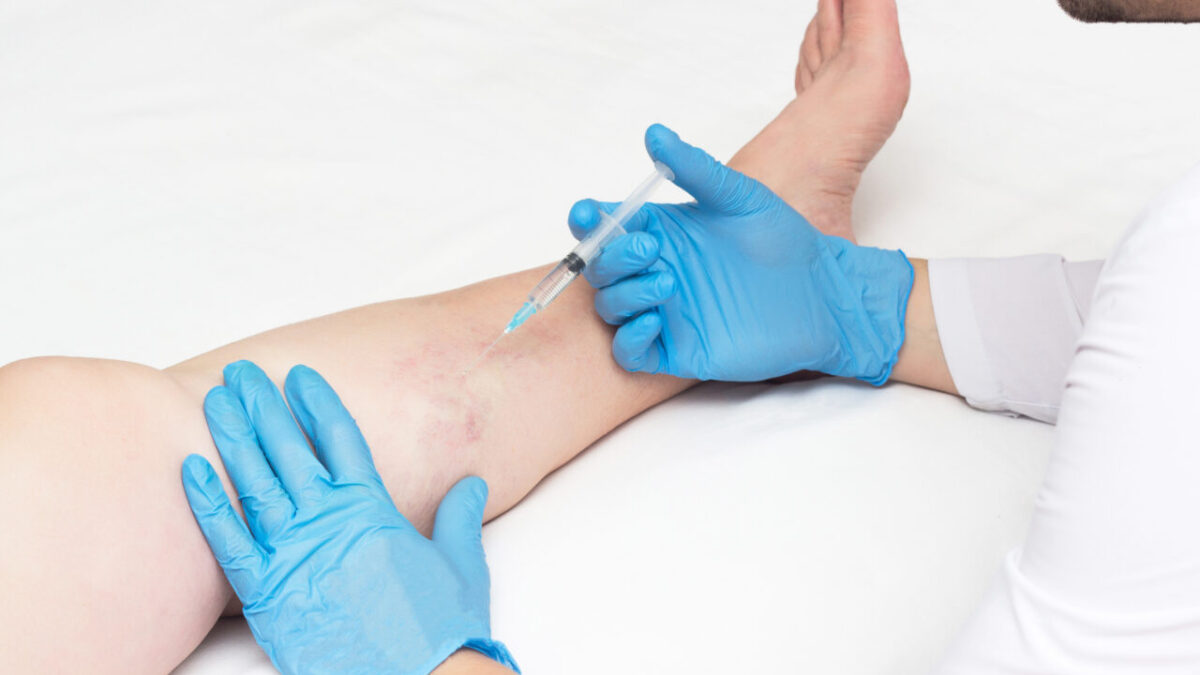 Common FAQs About Vein Disease