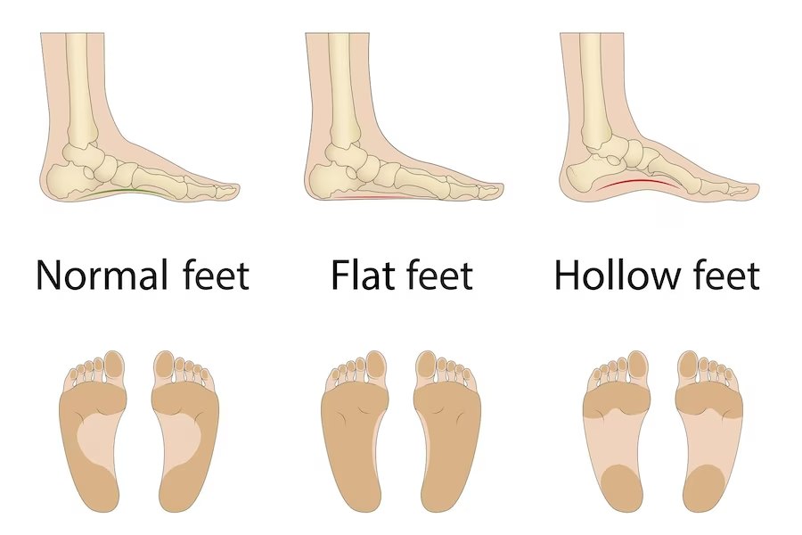 What Are the Two Types of Flat Feet Treatments?