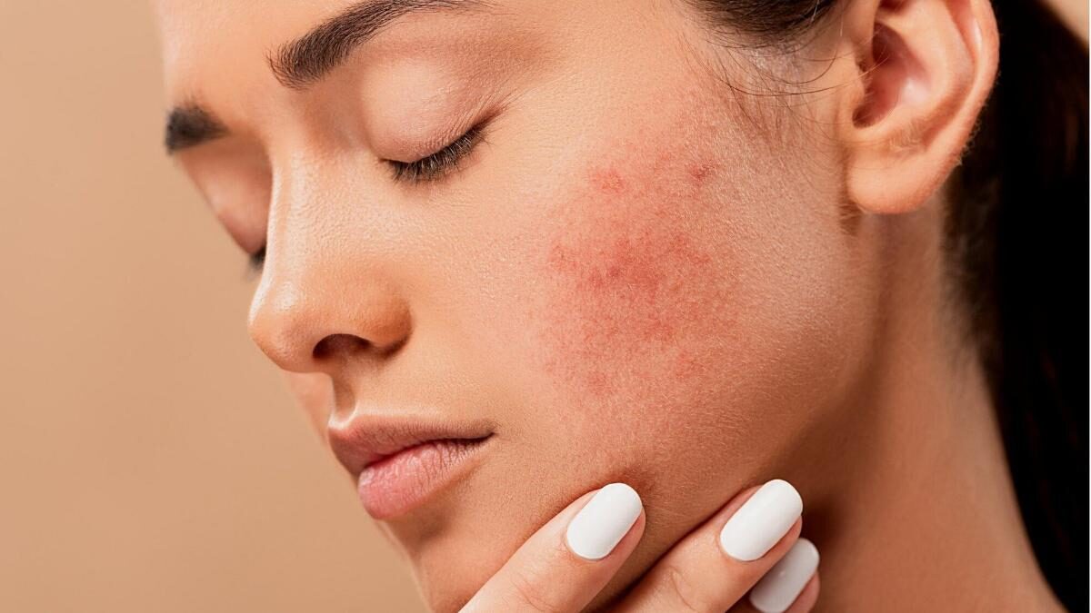 Manuka Honey Product: The Natural Solution for Treating Acne