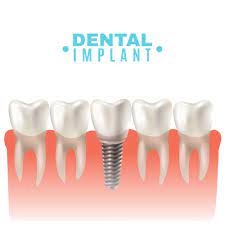 All-on-4 Dental Implants: A Comprehensive Solution for Full-Arch Restoration