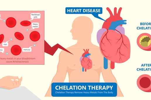 Decoding the Benefits Of Chelation Therapy in Canada