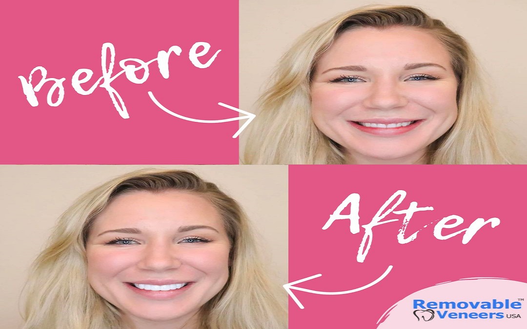 Smile Makeovers Simplified: Snap-On Veneers for Missing Teeth