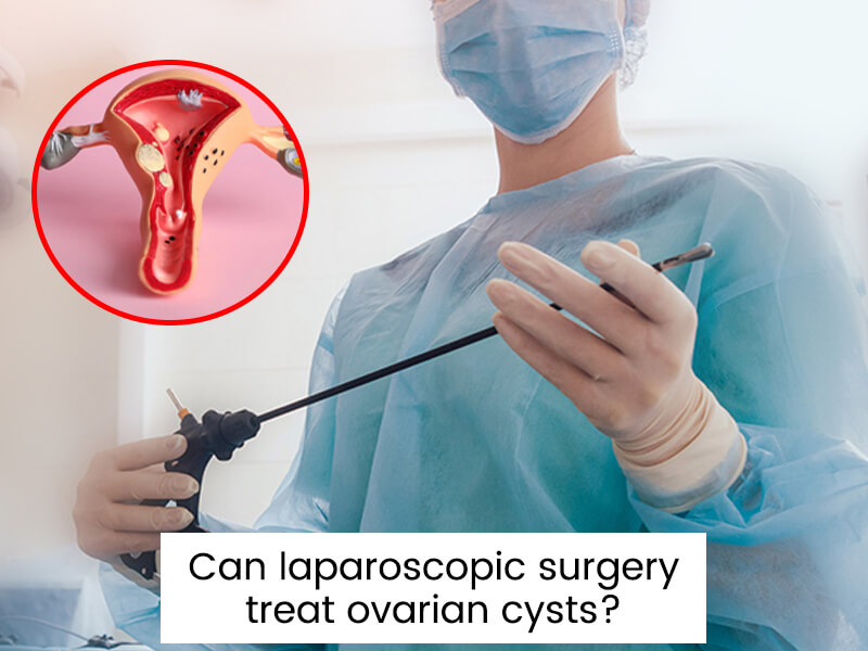 Can laparoscopic surgery treat ovarian cysts?