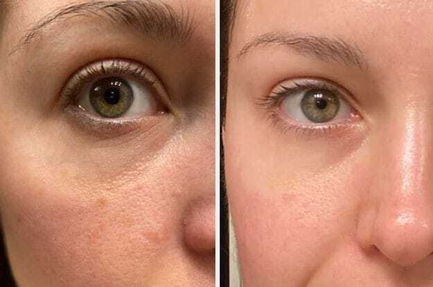 Unlocking the Beauty Secret: Laser Facial Treatments in Toronto