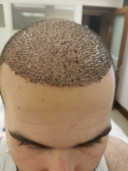 FUE Hair Transplant in Islamabad: Your Guide to a Fuller Head of Hair