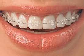 Invisible Braces by Floss Dental Clinic