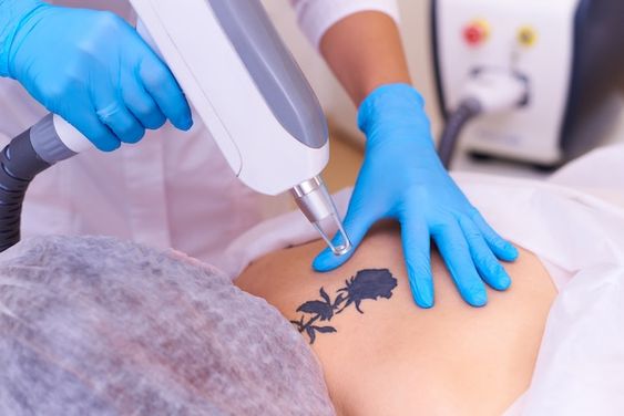 Unveiling the Canvas: The Art of Laser Tattoo Removal in Fort Lauderdale