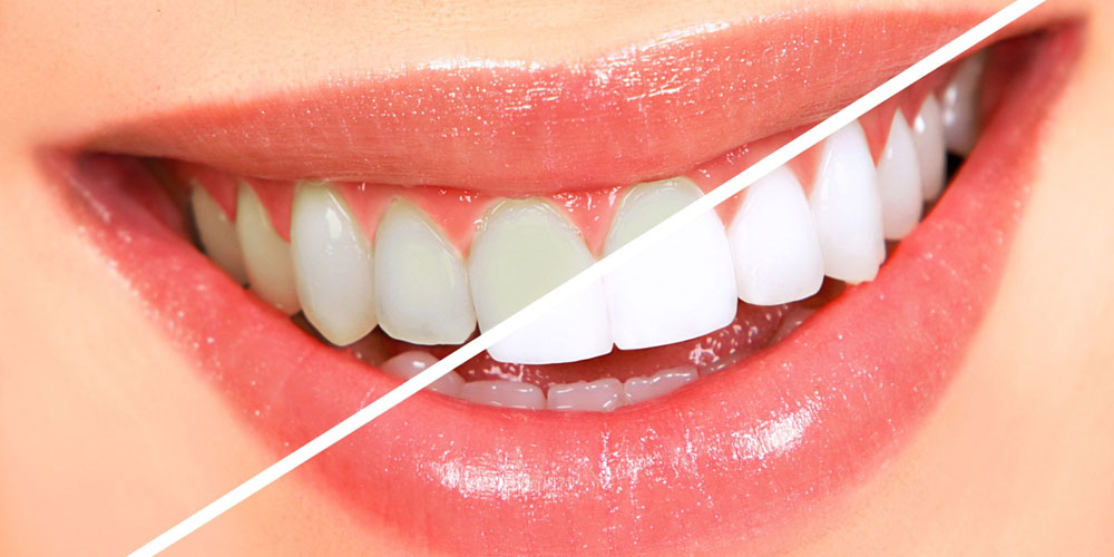The Impact of Diet on Teeth Whitening Results