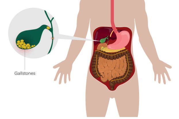 How to remove gallbladder stone without operation