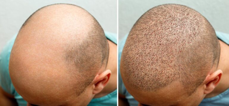 The Transformative Journey: Hairline Transplant Before and After