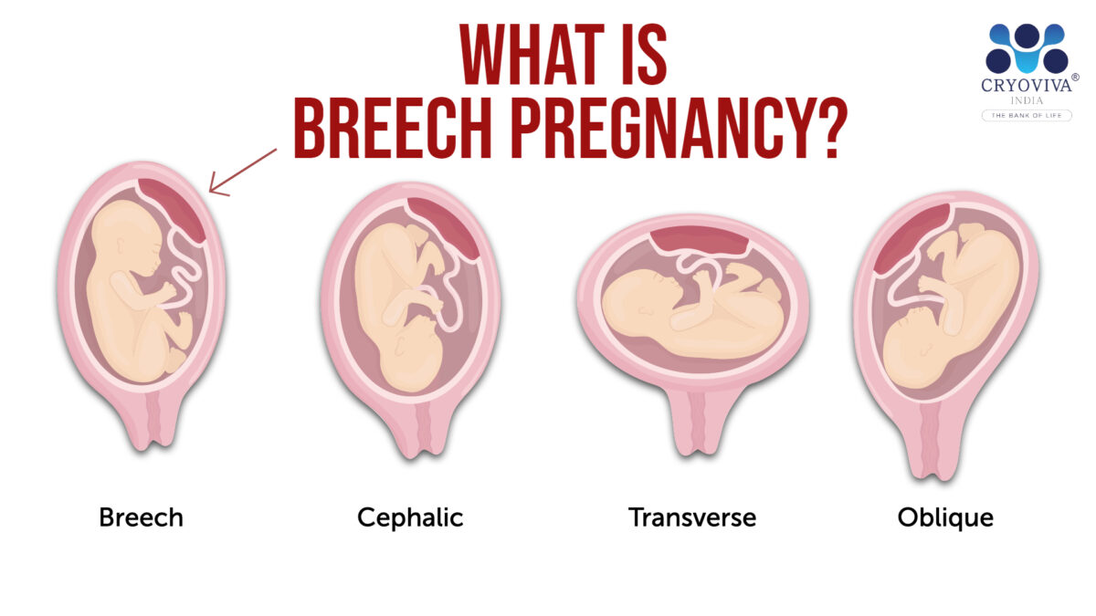What is Brееch Prеgnancy?
