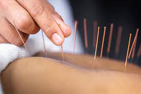 Exploring the Role of Acupuncture in Addiction Treatment