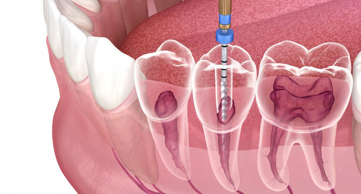 What Are the Procedures of Root Canal Treatment?