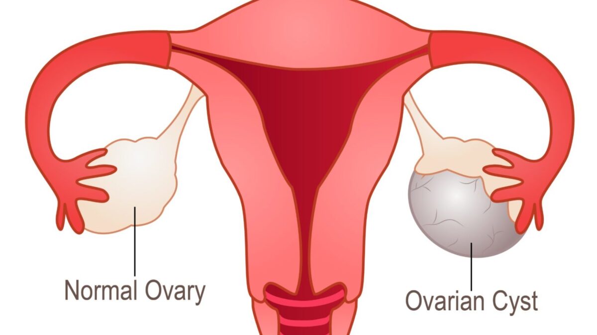 From Fibroids to Ovarian Cysts: A Guide to Benign Gynecological Tumors